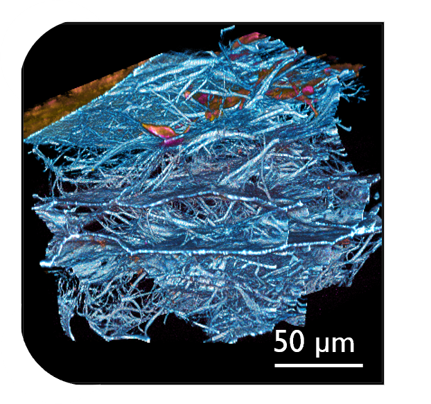 Ovarian-cancer-on-chip